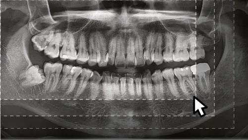 Free FOV функция свободного выбора области сканирования