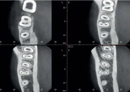 ENDO режим с разрешением 49.5 микрон - повышенная детализация