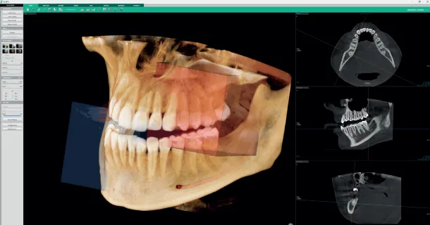 Smart Focus - множественные зоны сканирования КЛКТ